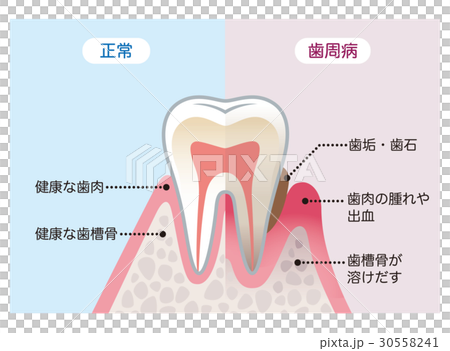 健康な歯と歯周病の歯 比較 健康な歯と歯周病の歯 比較 30558241