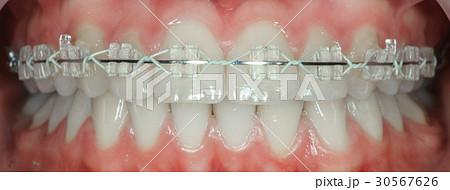 teeth with ceramic braces 30567626