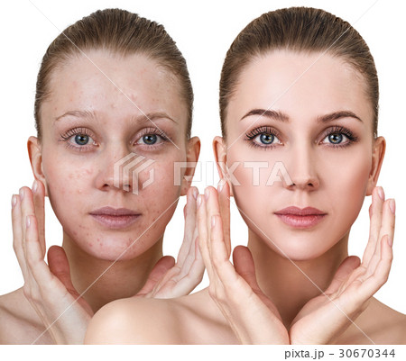 Woman before and after treatment and makeup. 30670344