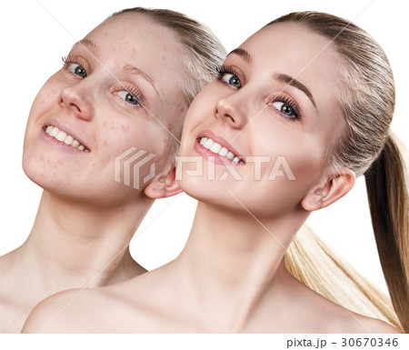 Woman before and after treatment and makeup. Woman before and after treatment and makeup. 30670346