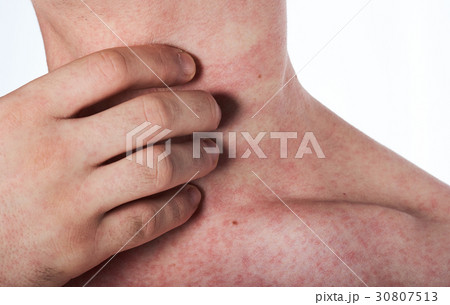 man scratching his neck with rash 30807513