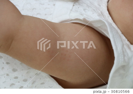 g痕 3週間経過後 の写真素材