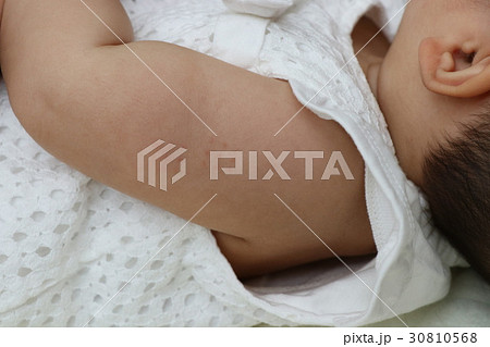 BCG痕(3週間経過後) BCG痕(3週間経過後) 30810568