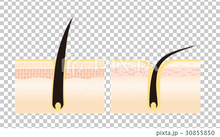 毛根 イラスト 毛根 イラスト 30855850