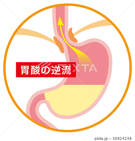 胃酸の逆流 逆流性食道炎 胃酸の逆流 逆流性食道炎 30924238