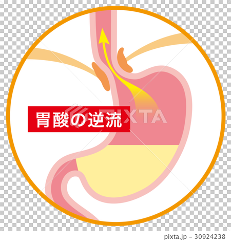 胃酸反流性食管炎 30924238
