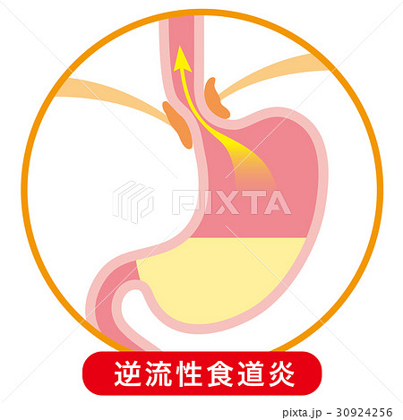 胃酸の逆流 逆流性食道炎のイラスト素材