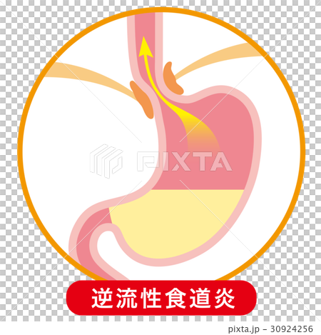胃酸の逆流 逆流性食道炎 胃酸の逆流 逆流性食道炎 30924256
