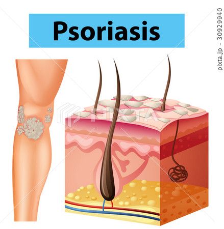 Diagram showing psoriasis on human skin 30929940