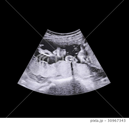 Ultrasound of baby in mother's womb. 30967343