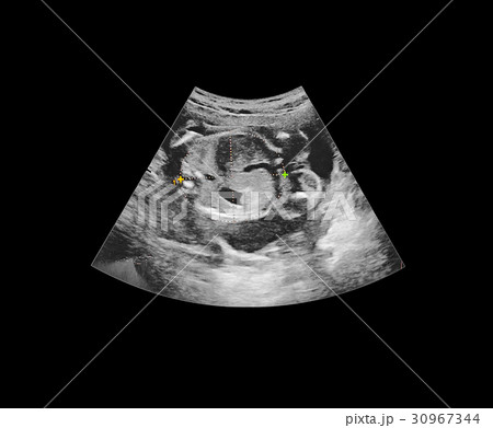 Ultrasound of baby in mother's womb. Ultrasound of baby in mother's womb. 30967344