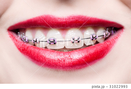 Teeth with braces Teeth with braces 31022993