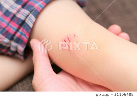 幼児 膝のケガ 幼児 膝のケガ 31106489