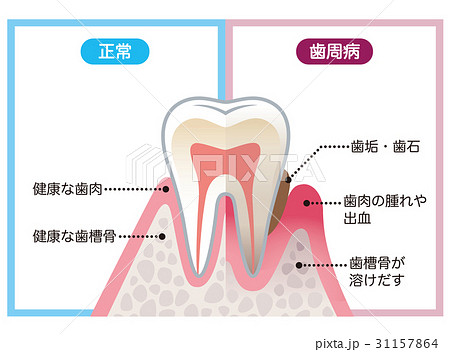 健康な歯と歯周病の歯 比較のイラスト素材