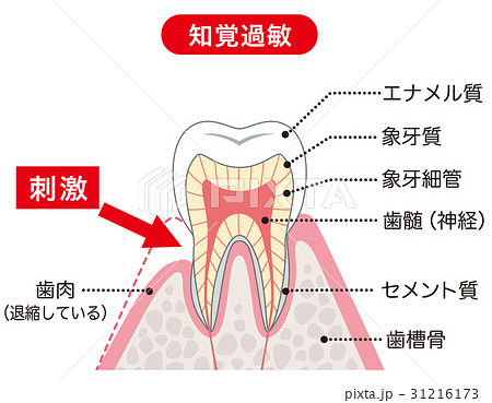 知覚過敏　医療　断面図 31216173