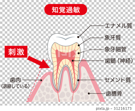 知覚過敏　医療　断面図 31216173