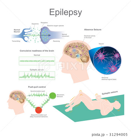 Epilepsy. Epilepsy. 31294005