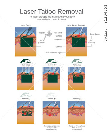 Laser Tattoo Removal 31294951
