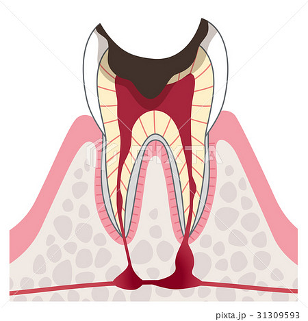 進行した虫歯 断面図のイラスト素材