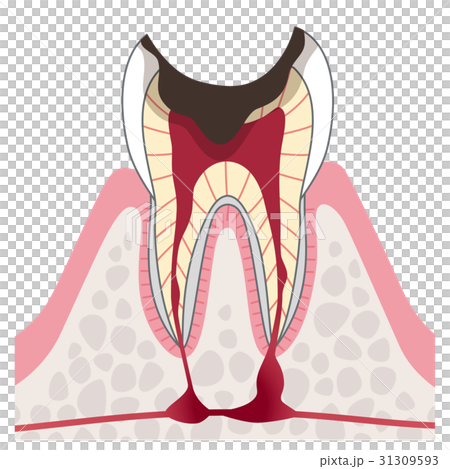 Advanced caries section view 31309593