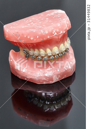 Jaw or teeth model with metal wired dental braces Jaw or teeth model with metal wired dental braces 31449832