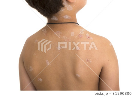 Kid with chickenpox Kid with chickenpox 31590800