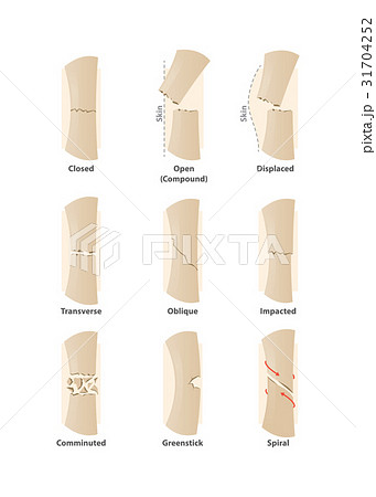 Type of fracture illustration vector on white. 31704252