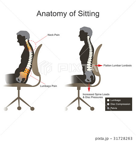 Sciatica. Health care info graphic vector. 31728263