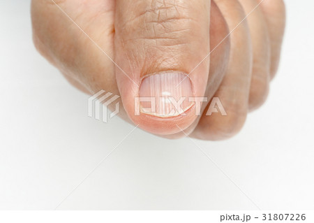 White spots and Vertical ridges on the fingernails 31807226