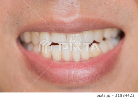 closeup mouth dental problem. Teeth Injuries 31884423