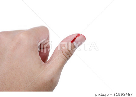 finger with bleeding wound on the thumb finger with bleeding wound on the thumb 31995467