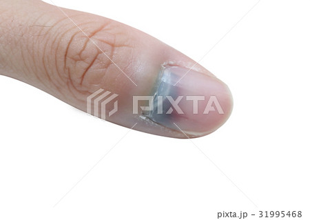 injured finger and bruised nail 31995468