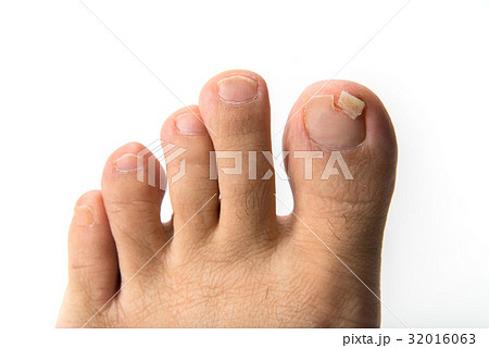 割れた爪 32016063