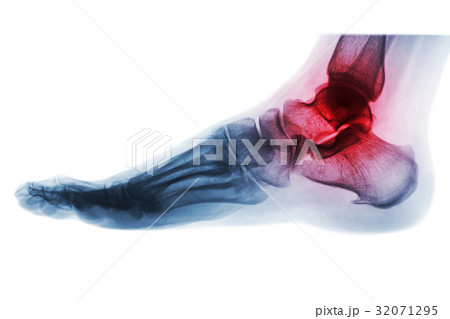 Arthritis of ankle . X-ray of foot . Lateral view  32071295