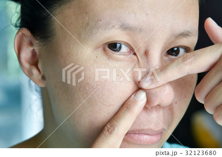 asian woman try to squeeze nose acne pimples asian woman try to squeeze nose acne pimples 32123680