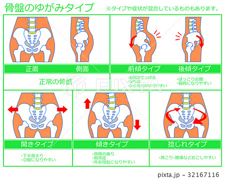 骨盤のゆがみ 分類図3 緑色 説明あり のイラスト素材