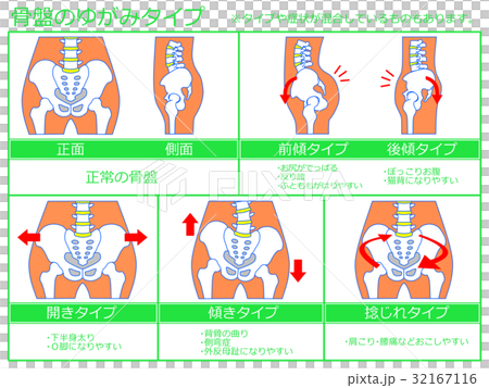骨盤のゆがみ・分類図3（緑色・説明あり） 32167116