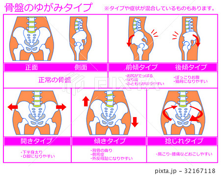 骨盤のゆがみ・分類図5(ピンク色・説明あり) 骨盤のゆがみ・分類図5(ピンク色・説明あり) 32167118