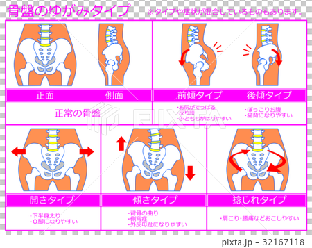 骨盤のゆがみ・分類図5(ピンク色・説明あり) 骨盤のゆがみ・分類図5(ピンク色・説明あり) 32167118