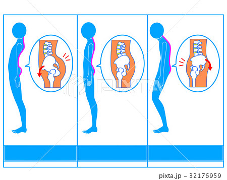 骨盤のゆがみ（前傾・正常・後傾）の比較　説明なし 32176959