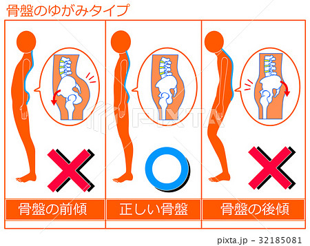 骨盤のゆがみ(前傾・正常・後傾)の比較 オレンジ色1 骨盤のゆがみ(前傾・正常・後傾)の比較 オレンジ色1 32185081