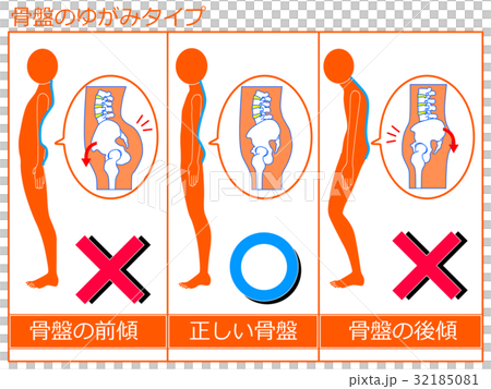 骨盤のゆがみ(前傾・正常・後傾)の比較 オレンジ色1 骨盤のゆがみ(前傾・正常・後傾)の比較 オレンジ色1 32185081