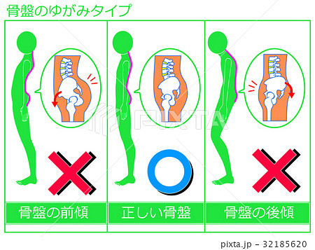 骨盤のゆがみ(前傾・正常・後傾)の比較 緑色1 骨盤のゆがみ(前傾・正常・後傾)の比較 緑色1 32185620