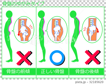 骨盤のゆがみ(前傾・正常・後傾)の比較 緑色1 骨盤のゆがみ(前傾・正常・後傾)の比較 緑色1 32185620