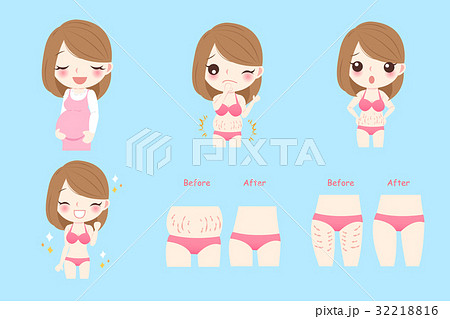pregnant woman with stretch marks pregnant woman with stretch marks 32218816