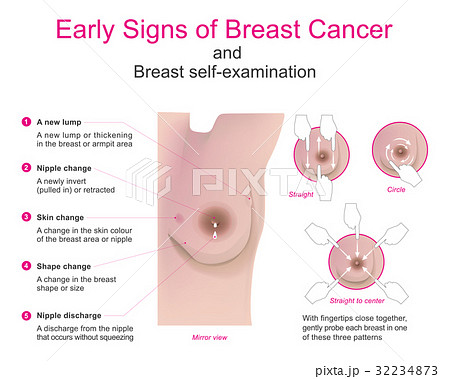 Early signs of breast cancer 32234873