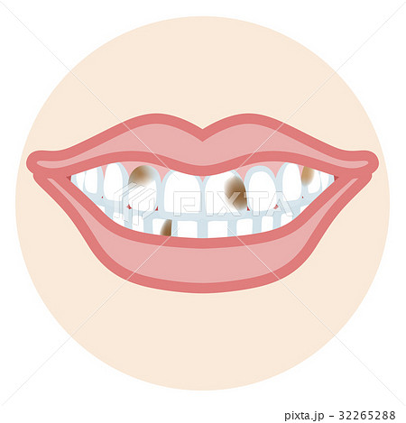 歯並び 口元アップ 虫歯のイラスト素材