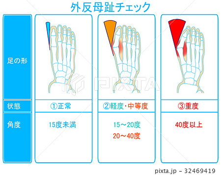 外反母趾の進行度チェック 青色 説明あり のイラスト素材