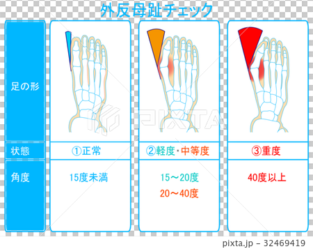 外反母趾の進行度チェック 青色 説明あり のイラスト素材