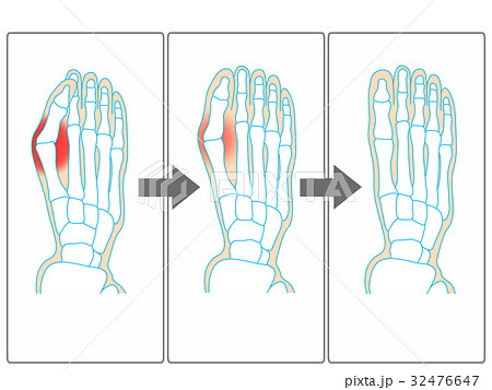 外反母趾の改善イメージ（灰色） 32476647